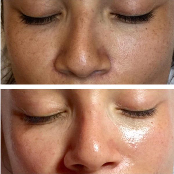Before and after microdermabrasion, oxygen infusion and LED treatment