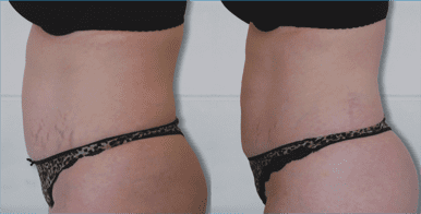 Lazer Lipo before and after results