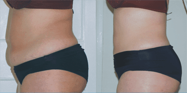 Lazer lipo before and after