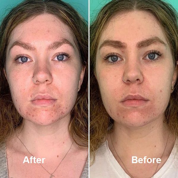 Chemical peel before and After