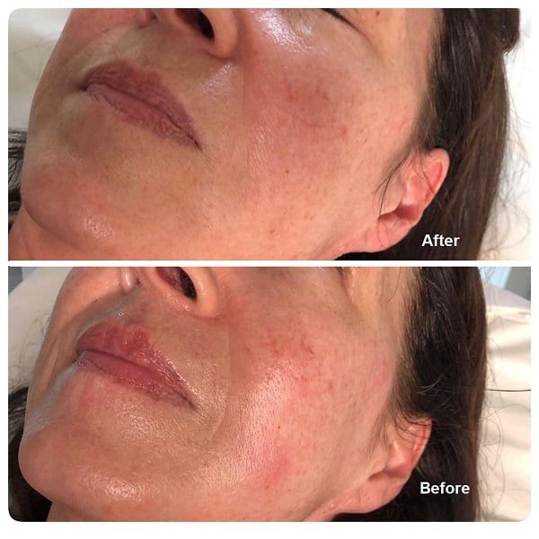 chemical peels before and after