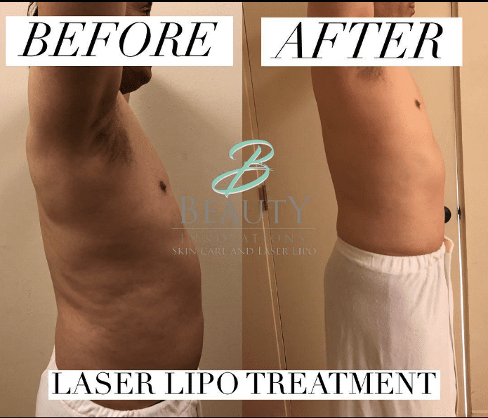 Laser Lipo Treatment Before And After