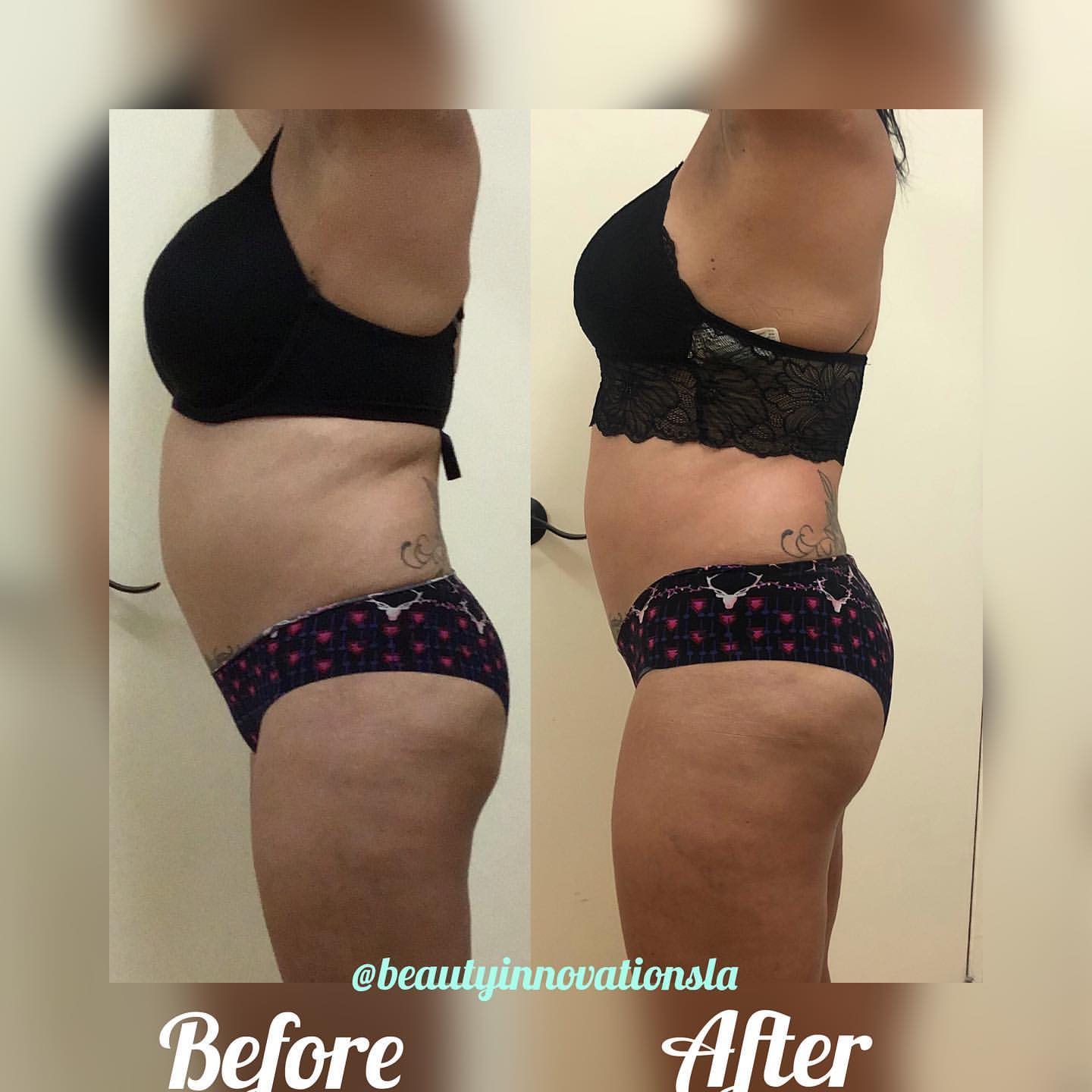 Laser Lipo Before And After Stomach
