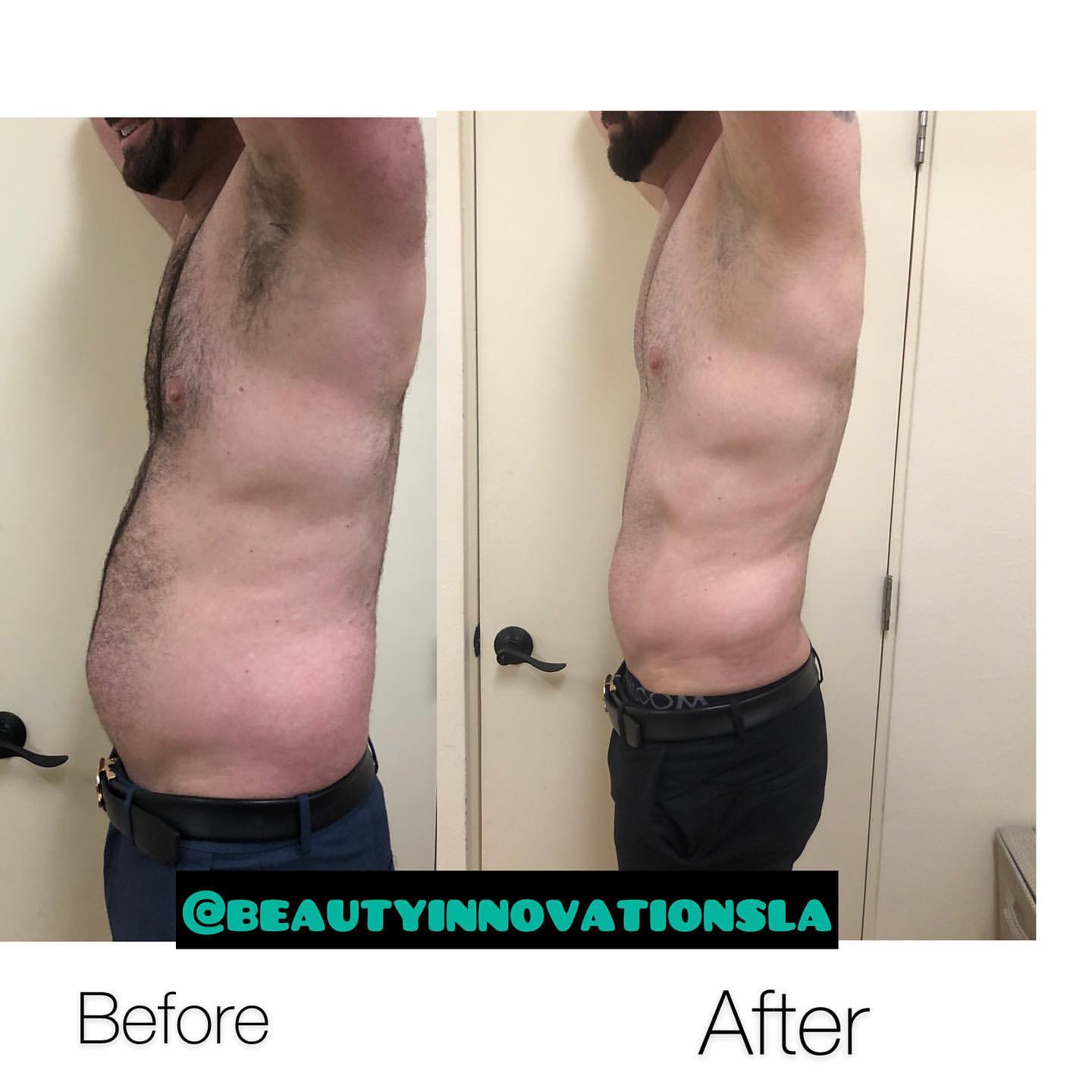 Stomach Laser Lipo Before And After 2 Treatment