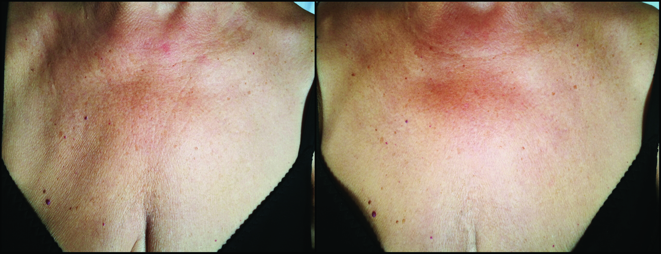 Upper Chest And Neck Laser Lipo Contouring 1 session