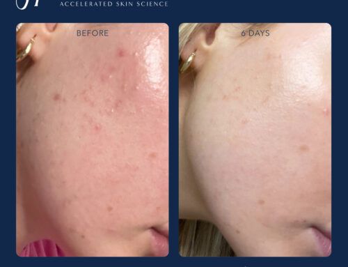 Hydrinity Skin Treatment in Marina Del Rey | Beauty Innovations