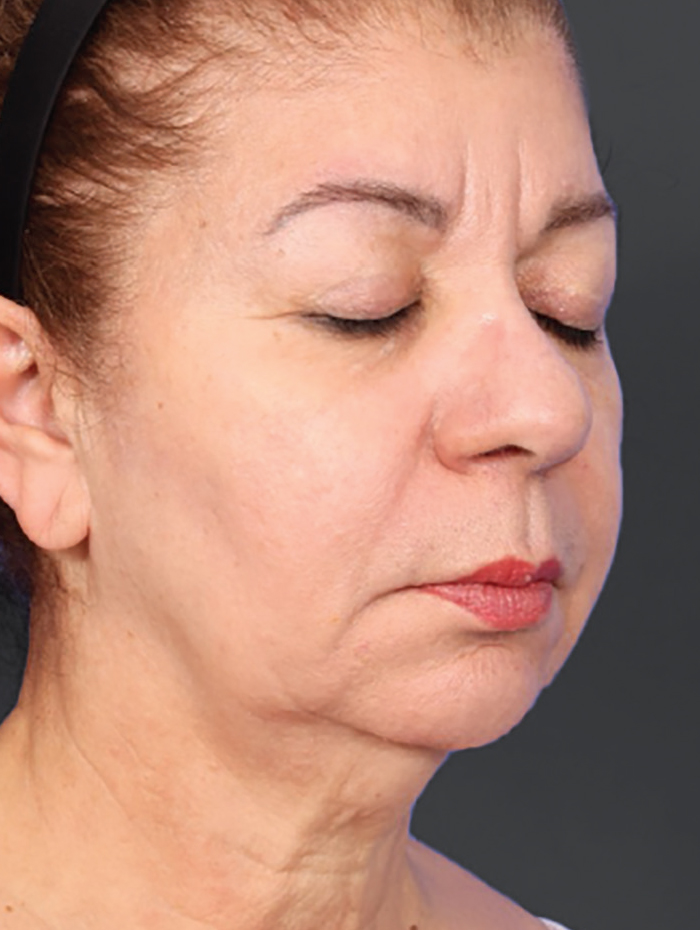 After 1 Treatment