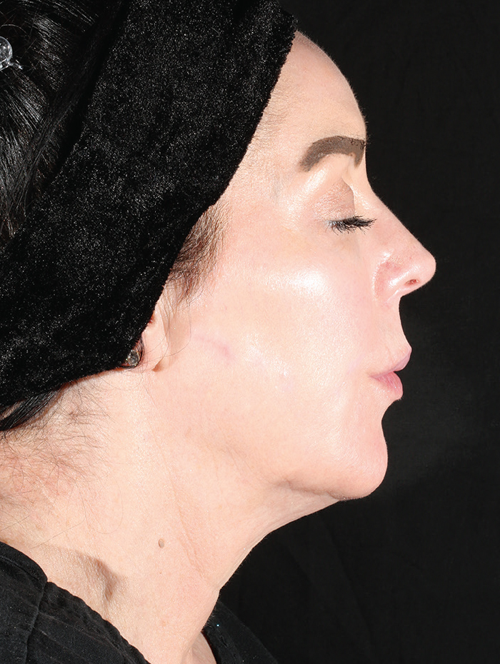 After 2 Treatments