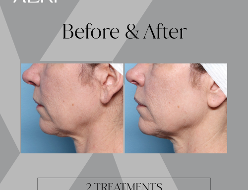 GLP-1 Weight Loss and Skin Laxity: How Radiofrequency Skin Tightening Can Help You Look as Good as You Feel