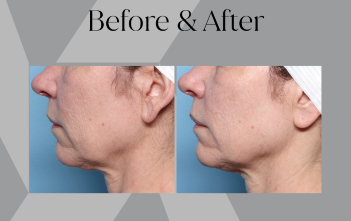 before-and-after-Dr-Jordan-Wang-XERF