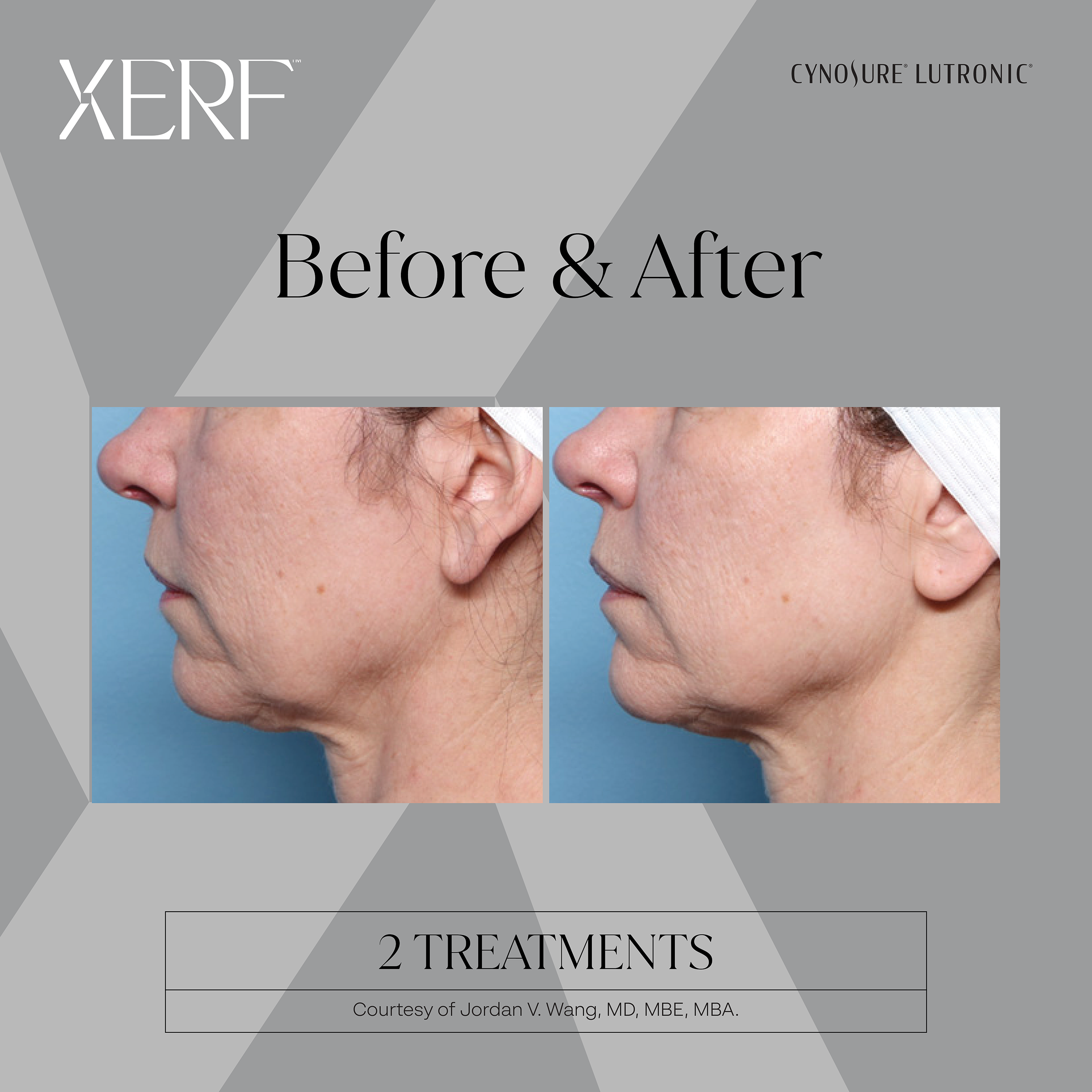 before-and-after-Dr-Jordan-Wang-XERF