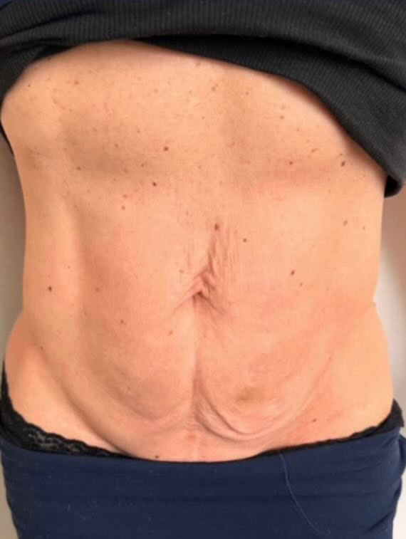 stomach-before-after