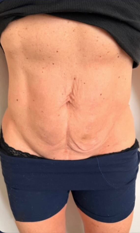 Before XERF (After GLP-1)